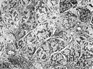 M,2y. | nephroblastoma (Wilms tumor) M,2y. | nephroblastoma (Wilms tumor)